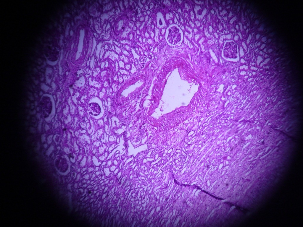 [renalcellcarcinomahistopathology2.jpg]