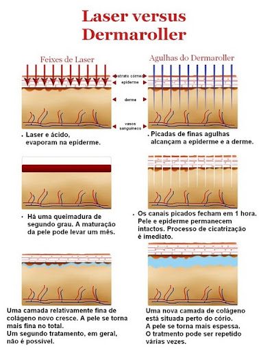 Laser Versos Dermaroller Resultado