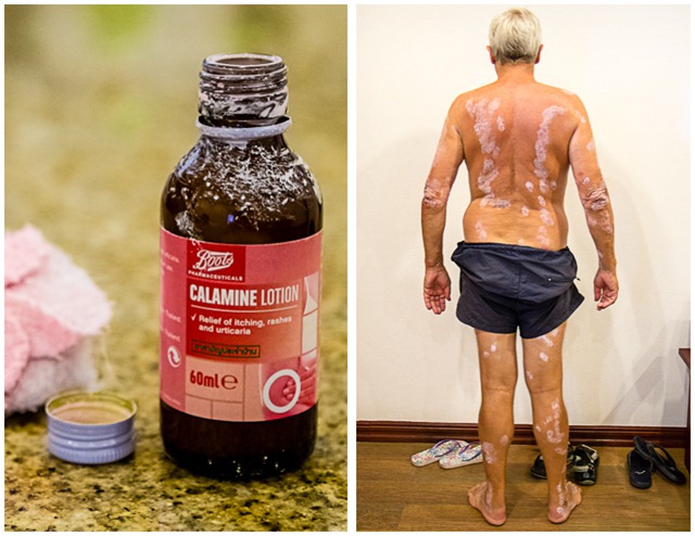 Calamine lotion Calamine lotion