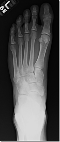 Foot Xray