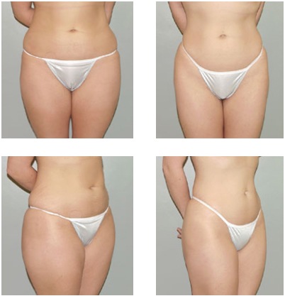 [liposuction-surgery5%255B4%255D.jpg]