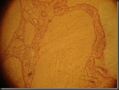 Colloid Goitre- high resolution histology slide tsnaps Colloid Goitre- high resolution histology slide tsnaps