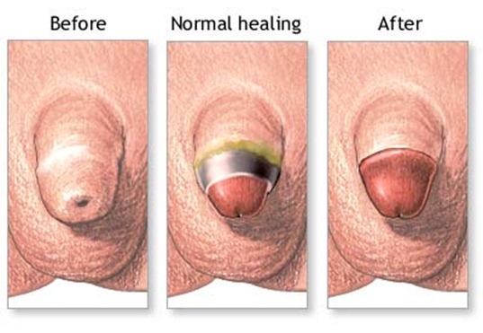 circumcision EQUAL MONEY