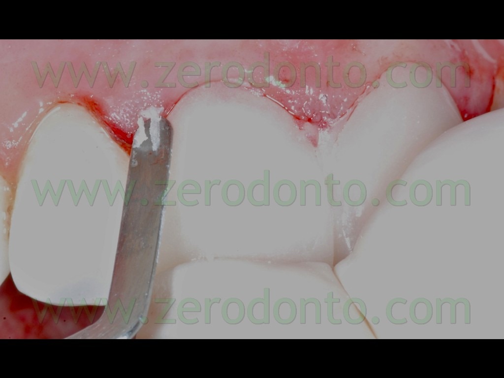 [76-ribasatura-veneers-provvisorie4.jpg]