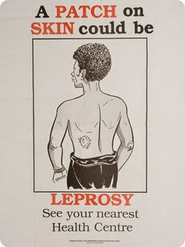 day leprosy