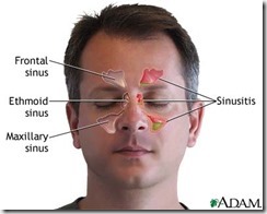 acupuntura curitiba rinite sinusite 3