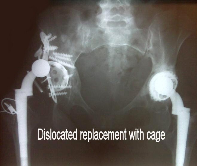 [preop_dislocated_cage_-_AP_pelvis%255B3%255D.jpg]