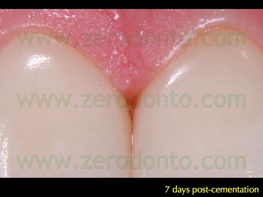 [130-papilla-interincisiva-interdenta%255B1%255D.jpg]