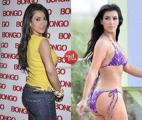 booty implants of Kim Kardashian