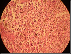 Hodgkin's Lymphoma high resolution histology slide tsnaps