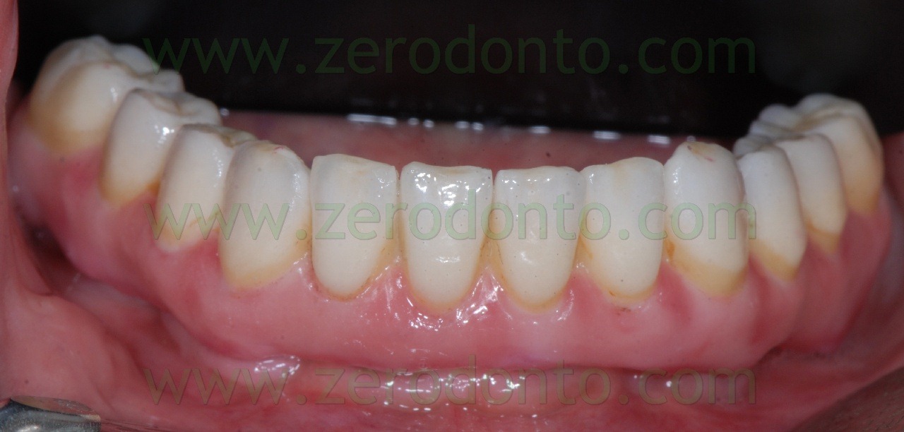 [full-arch-zirconia2.jpg]