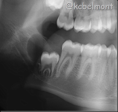 cisto dentgero 48 cisto dentgero 48