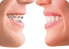 隱適美數位牙齒矯正Invisalign 隱適美數位牙齒矯正Invisalign