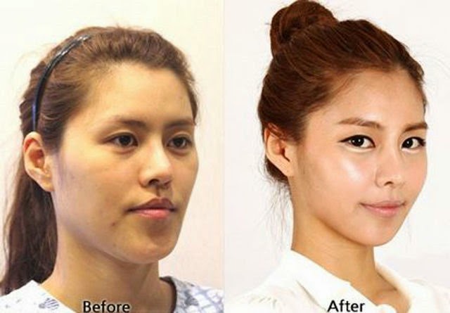 [korean-plastic-surgery-11%255B2%255D.jpg]