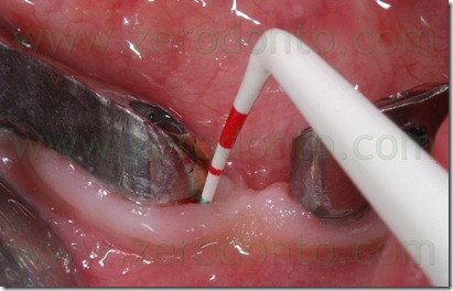 bleeding on probing follow up