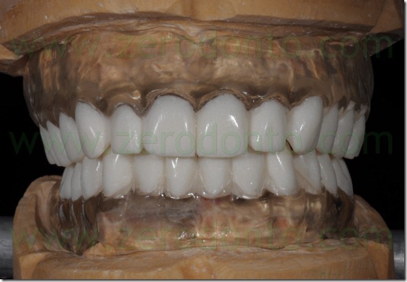 - (48) denti in bario