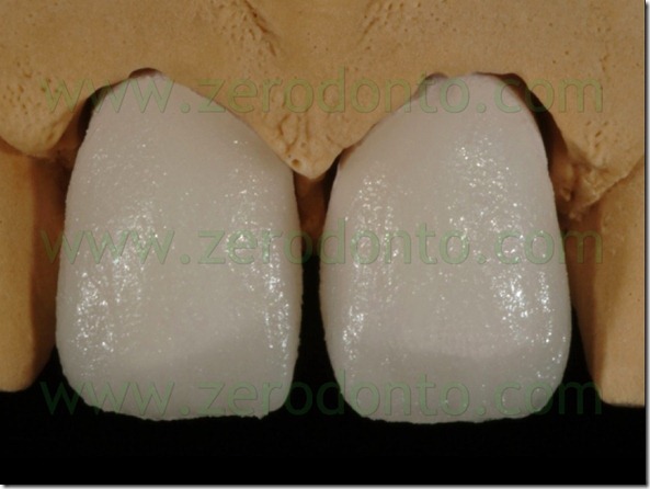89 stratificazione ceramica massa smalto faccette