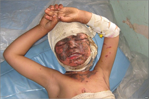 c0 an Afghani child injured in the conflict