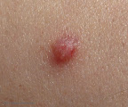 verruga-VPH verruga-vph.bmp