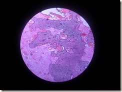 osteosarcoma histopathology slide