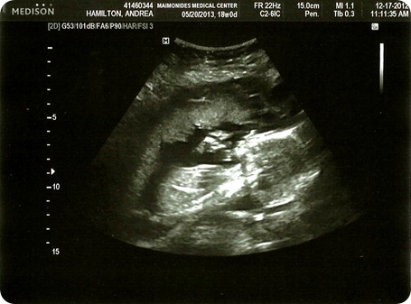 Twin A Baby Girl 18 Weeks