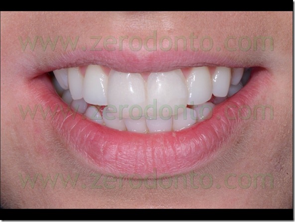 26 linea del sorriso