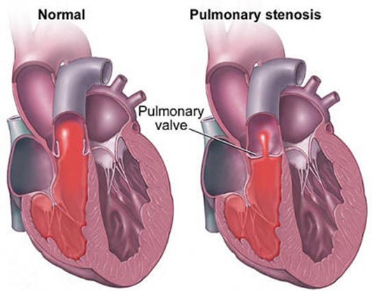 pulmonary-stenosis pulmonary-stenosis