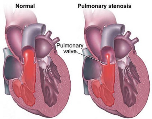 pulmonary-stenosis