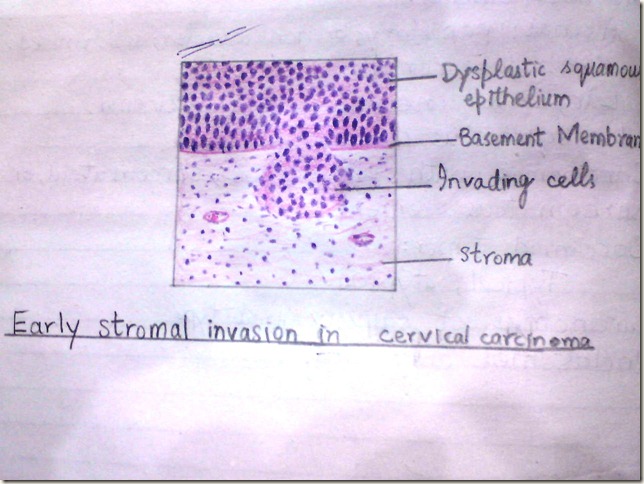 stromal invasion in cervical carcinoma-histopathology