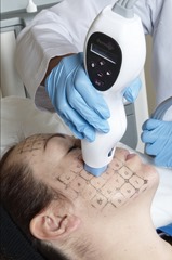Thermage Treatment_different tip