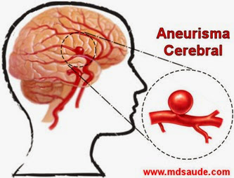 Aneurisma cerebral