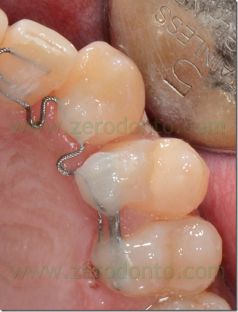 22 denti storti bis