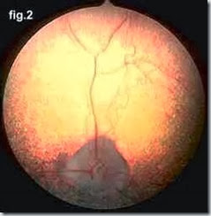 atrofia progressiva retina