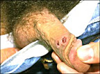 hombre-con-sifilis.jpg