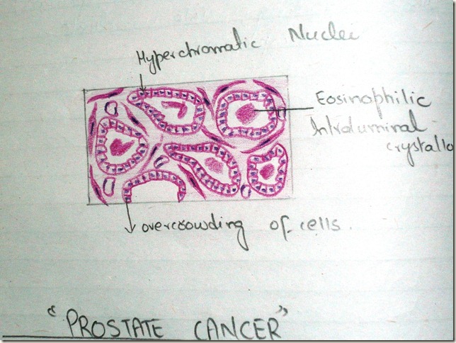 ca prostate diagram histopathology