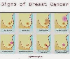 [breast%2520cancer%2520signs%255B6%255D.jpg]