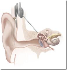 Cochlear_implant