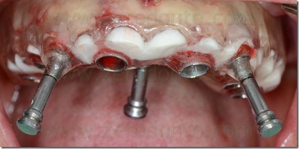 - (232) pin di stabilizzazione