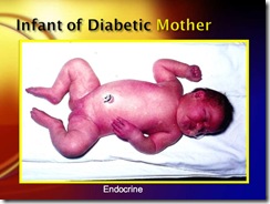 infant of diabetic mother