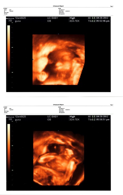 20120420 Ultrasound Boy Gusa