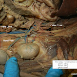 celiac_trunk_L.JPG
