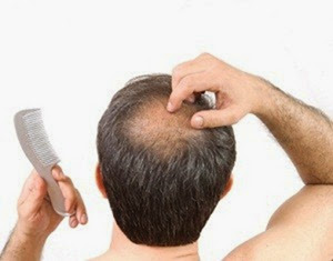 Ten Pros and Cons of Non- Surgical Hair Replacement : Appreciating the  advantages of hair replacement systems and Weighing the disadvantages of  hair systems