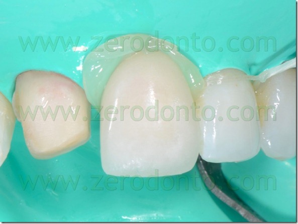 115 rimozione cemento veneers