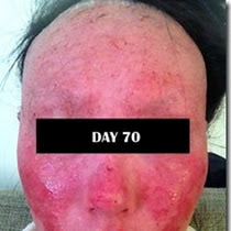 Topical corticosteroids for face
