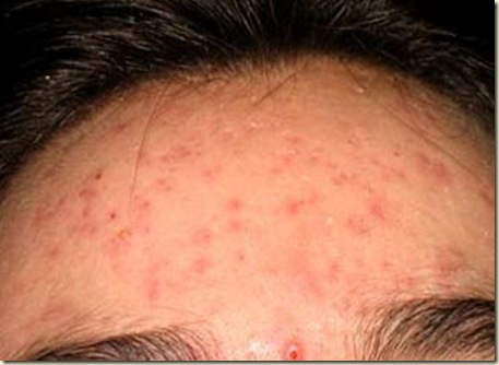 acne14 acne14