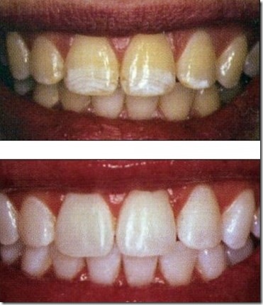 the bleaching of teeth a review During this procedure a rubber dam is put over your teeth to protect the gums, and a bleaching product is painted onto your teeth. the bleaching of teeth a review During this procedure a rubber dam is put over your teeth to protect the gums, and a bleaching product is painted onto your teeth.