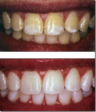 teeth bleaching