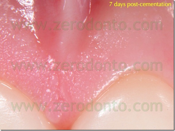 129 precisione adattamento margine veneers ceramica
