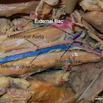 abdominal_aorta_L.JPG