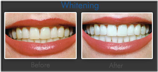 teeth_whitening